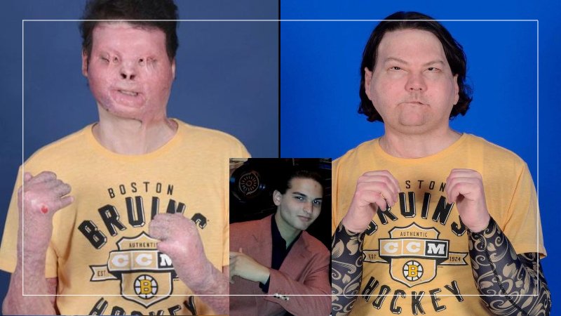 New Jersey man gets world’s first double face, hand transplant